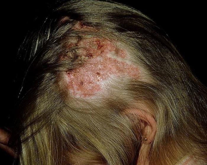 fejbőr betegségek képekkel - Minden információ a bejelentkezésről